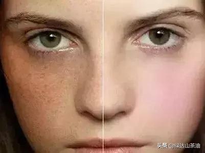 夏季肌肤问题频出？炎炎夏日防晒护肤，一瓶山茶油全搞定