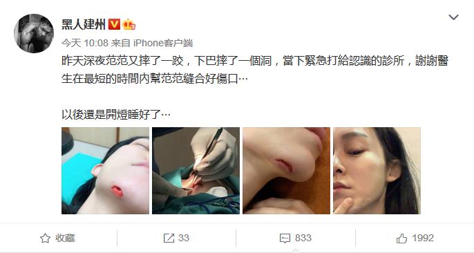 范玮琪深夜摔跤，下巴被摔一个洞，陈建州晒图吓坏网友