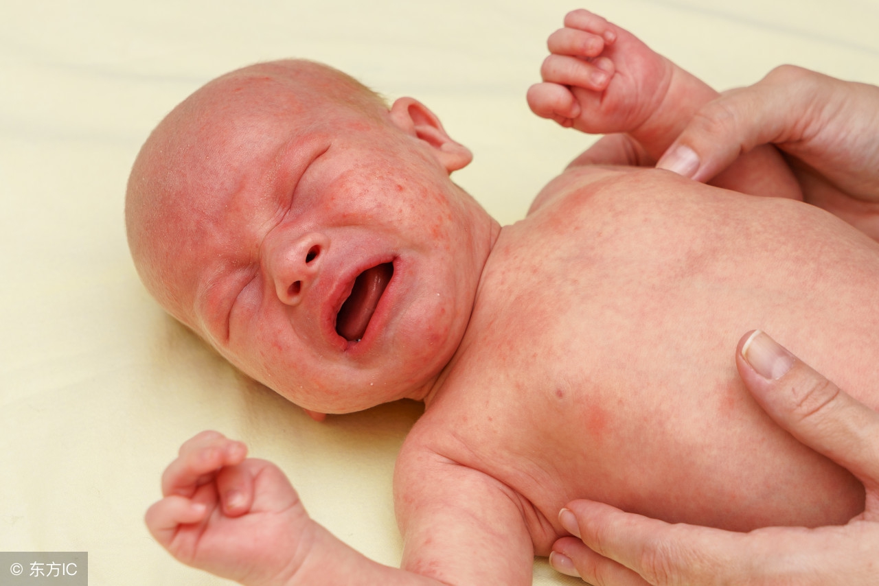 治疗不如预防这句话怎么说,儿童湿疹怎么防抓痒