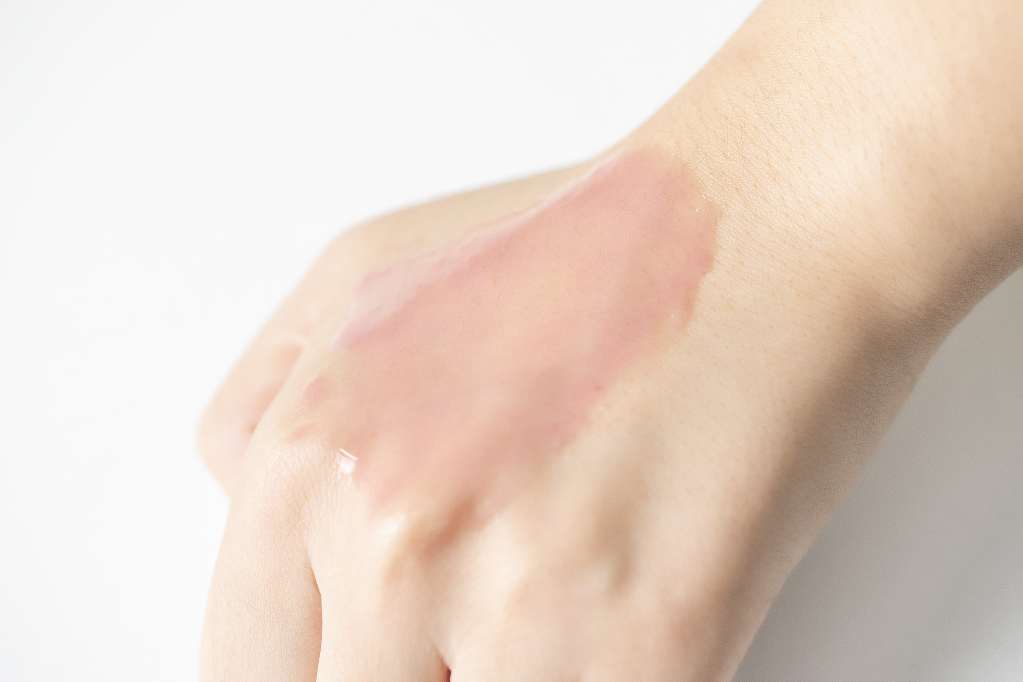 解决黑头的2种药,解决黑头的最好方法