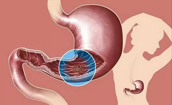 胃溃疡吃什么调理最好,胃溃疡能吃植物油吗