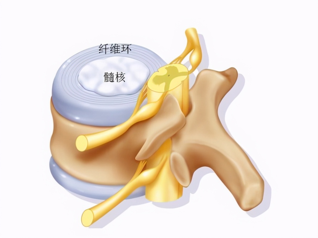 腰椎间盘突出和椎管狭窄有何区别,椎管狭窄和腰椎间盘突出的区别