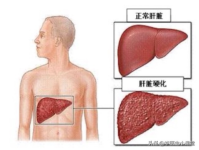 肝癌晚期真的是必死无疑吗,肝癌晚期为什么还可以活很久