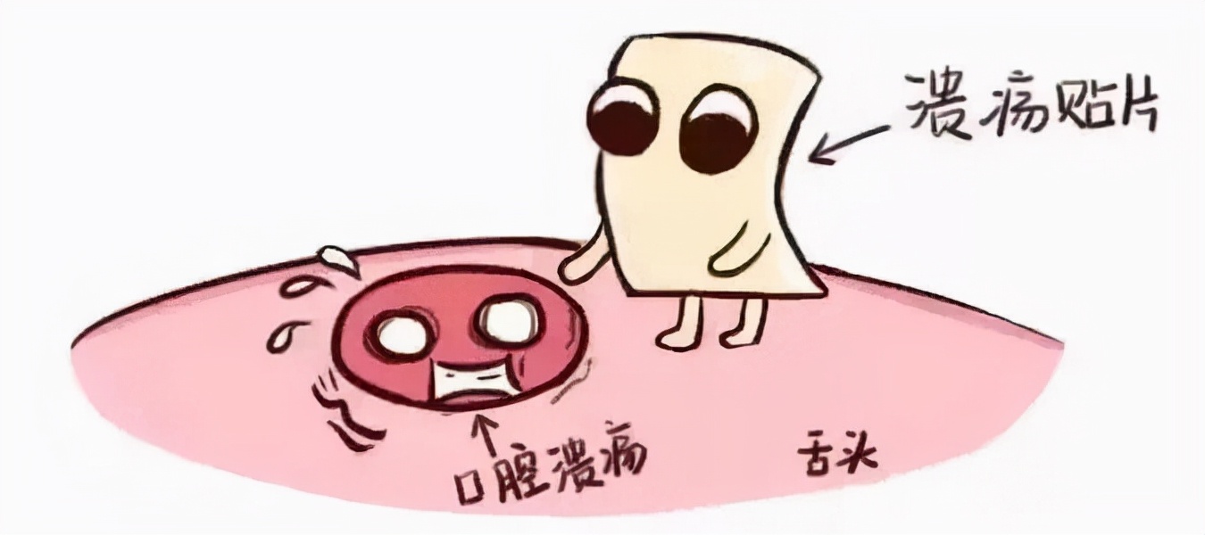 日常生活中应如何应对口腔溃疡,孕妇如何应对口腔溃疡