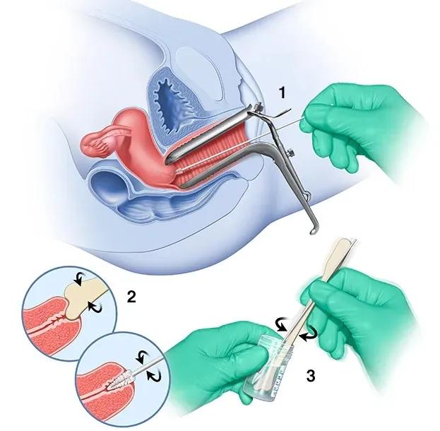 怀疑自己得了尖锐性湿疣怎么排除,怀疑自己得了尖锐性湿疣怎么治疗
