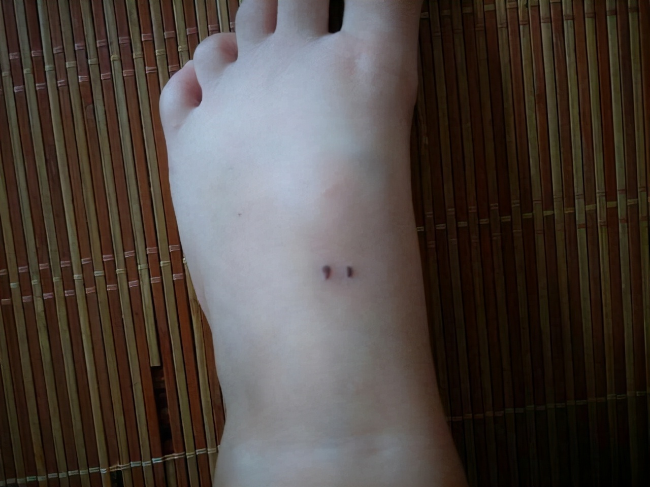 红霉素软膏作用与功效能治脚气吗,2块钱一支的红霉素