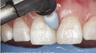 门牙裂了一条缝,门牙有缝的女人