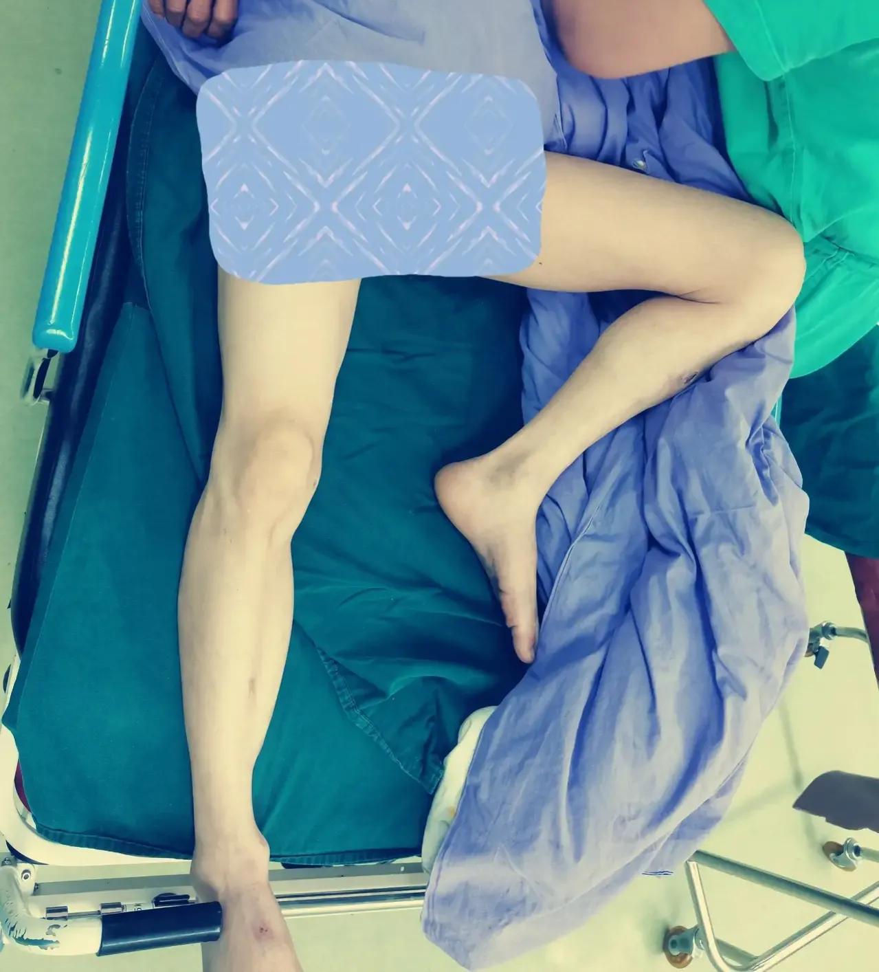 髋关节脱位闭合复位方法,髋关节脱位复位治疗过程