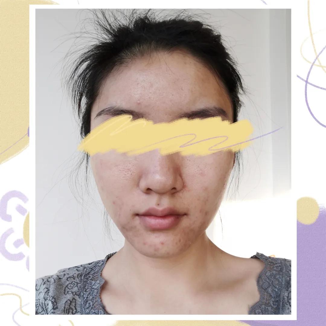 医美做什么能永远不长痘,脸很多痘坑做什么医美
