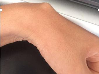 手上无缘无故多了个包，如何是好？