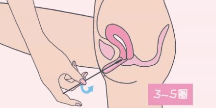 小姐姐居然把尖锐湿疣当毛囊炎,真替她的智商捉急!