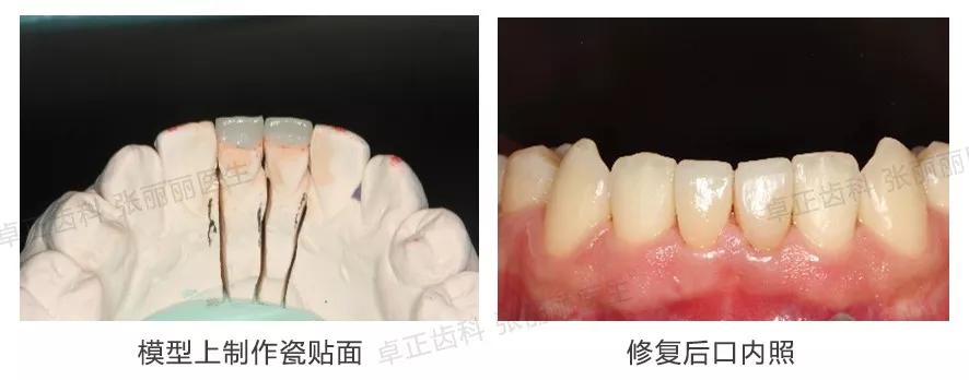 牙齿缺损全瓷冠修复多少钱,牙齿楔状缺损修复大概多少钱