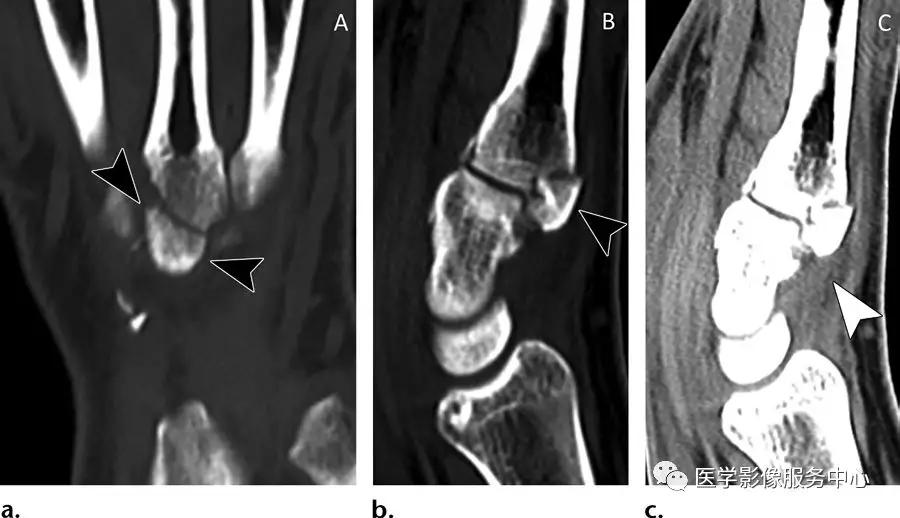 手腕撕脱性骨折一年了还隐隐作痛,手腕三角骨撕脱骨折症状有哪些