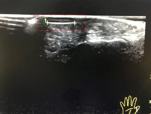玻璃扎进手指了取不出来,玻璃扎进手指里取不出来怎么办