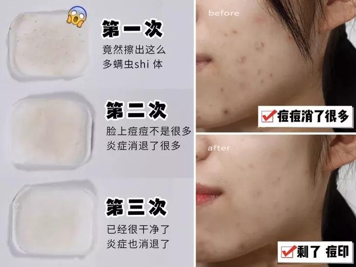 专治螨虫的洗面奶,螨虫专用洁面乳