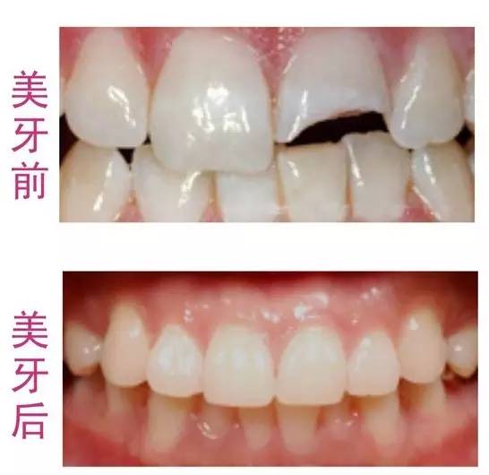 Helen齿科中心——如何选择牙套的材料？