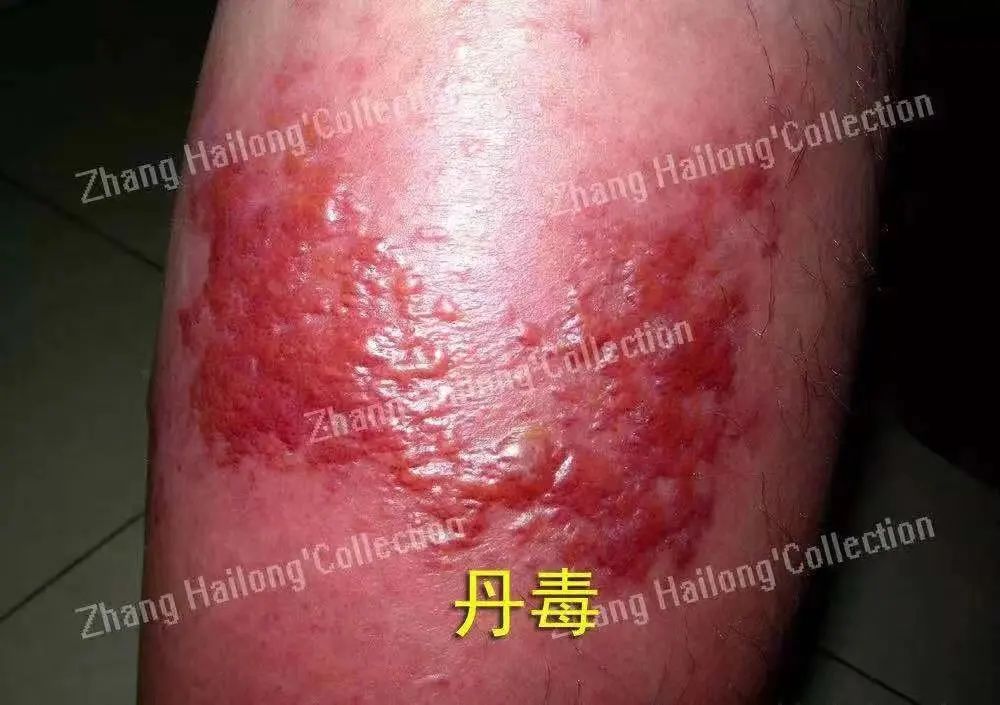 足癣和丹毒的区别,足癣和脚气一样吗