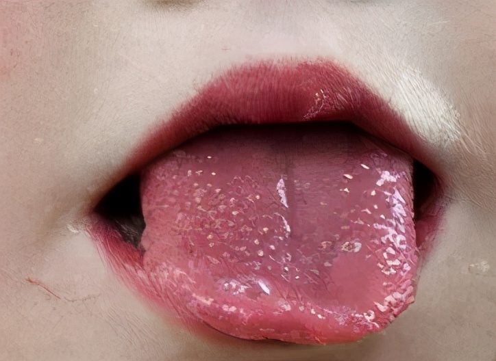 猩红热是幼儿最常见的传染疾病,猩红热可以用疫苗预防吗