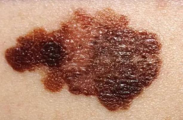 医生提醒:皮肤长出这种痣,十有八九是黑色素瘤,要及时清除!