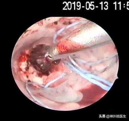 球囊扩张血肿怎么办,经皮穿刺脑血管腔内球囊成形术