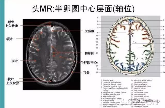 电子版头颅ct与mri断层解剖,头颅mri血管解剖与分段详解