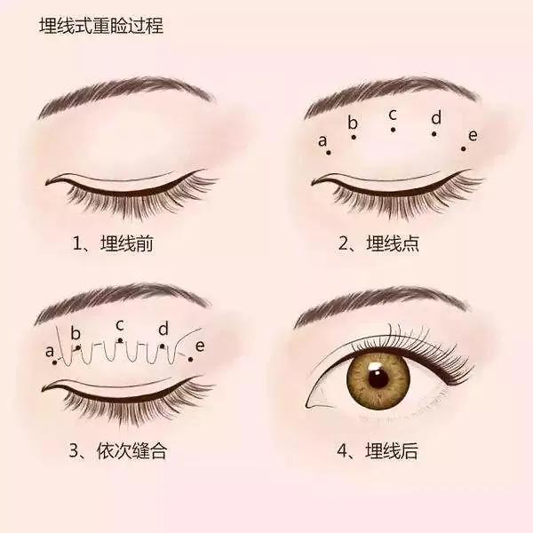 埋线法双眼皮的效果,郑州埋线法双眼皮手术价格