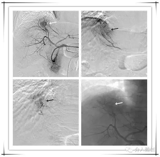 原发性肝癌伴门静脉癌栓能活多久,原发性肝癌介入治疗及进展