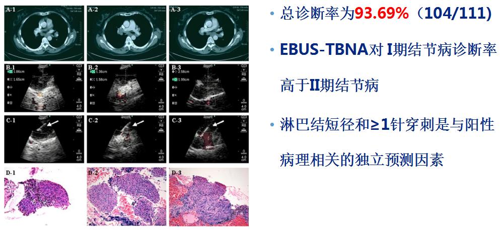 小细胞肺癌的气管镜介入治疗,导航支气管镜在肺癌诊断中的应用