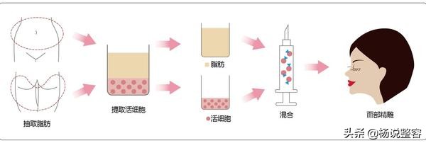 科普：自体脂肪面部填充有哪些优缺点、有哪些风险呢？