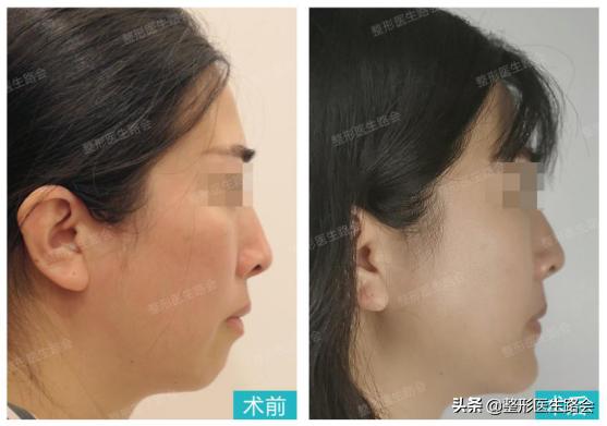 想要垫下巴│材料怎么选？手术疼不疼，过程怎样？听她亲口跟你说