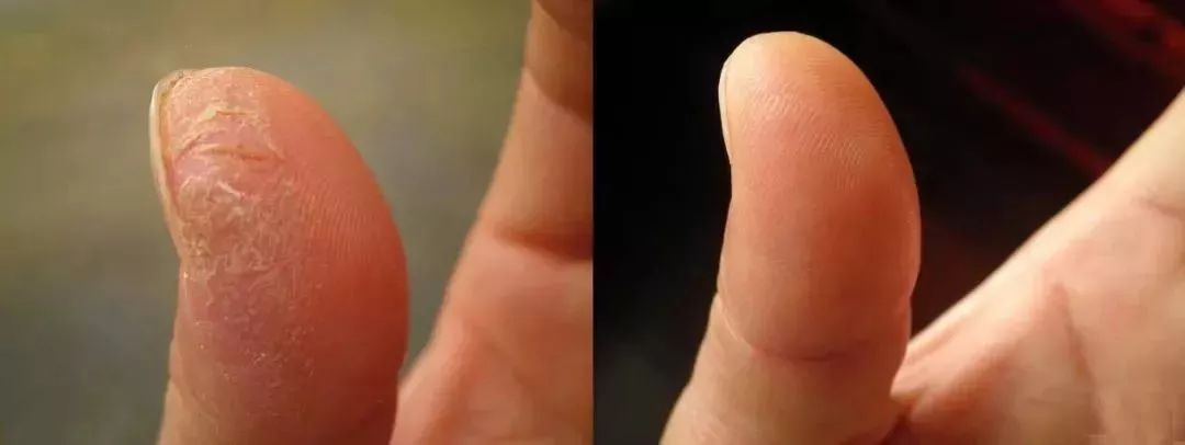 冬天脚后跟干裂用什么润脚霜,润足脚后跟干裂修复霜