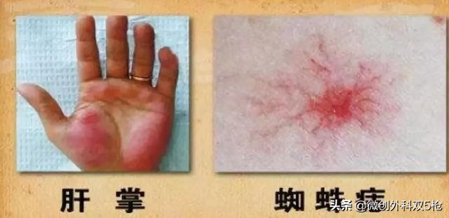 有乙肝大三阳经常喝酒会怎么样,乙肝大三阳经常喝酒会怎么样