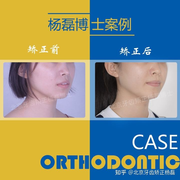 北京牙齿矫正大约要多少钱,北京哪个医院看牙齿矫正比较好