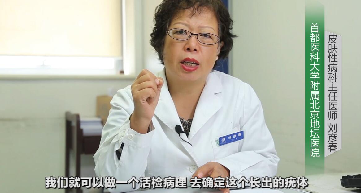 尖锐性湿疣检查查哪些项目,尖锐性湿疣需要检查什么项目