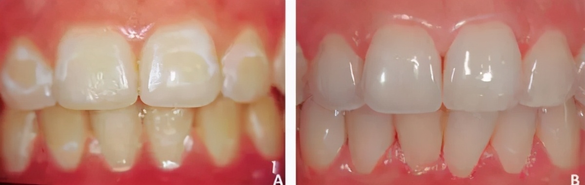 牙齿脱矿了如何补救,牙齿脱矿了怎么治