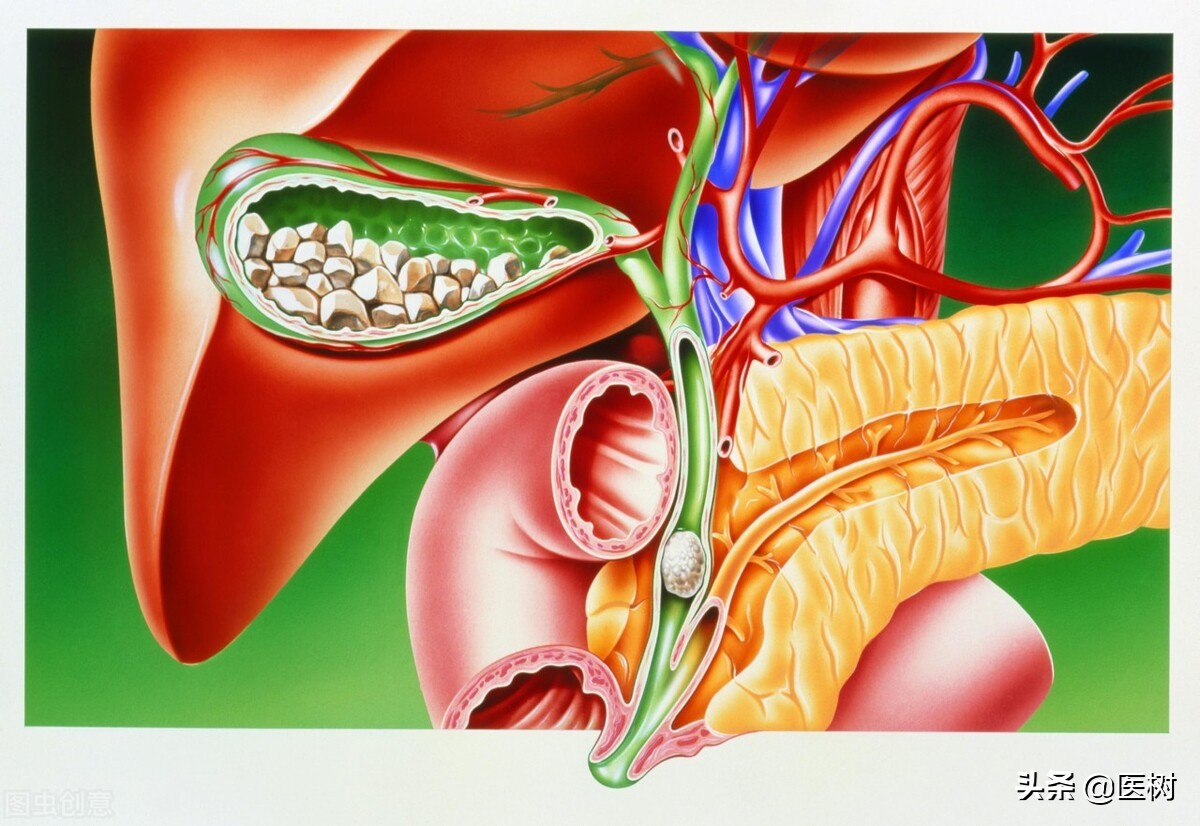 胆结石手术后可以预防胆管结石吗,胆囊结石和胆结石哪个严重一点