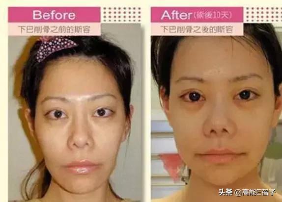 微整形需要多久,微整形后多久恢复正常