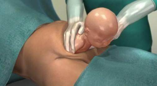 为什么越来越多的孕妇选择剖腹产,为什么现在选择剖腹产的会这么多