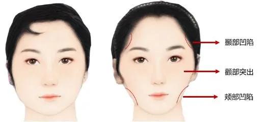 牙套脸怎么恢复原来脸型,整牙齿的牙套脸可以恢复吗