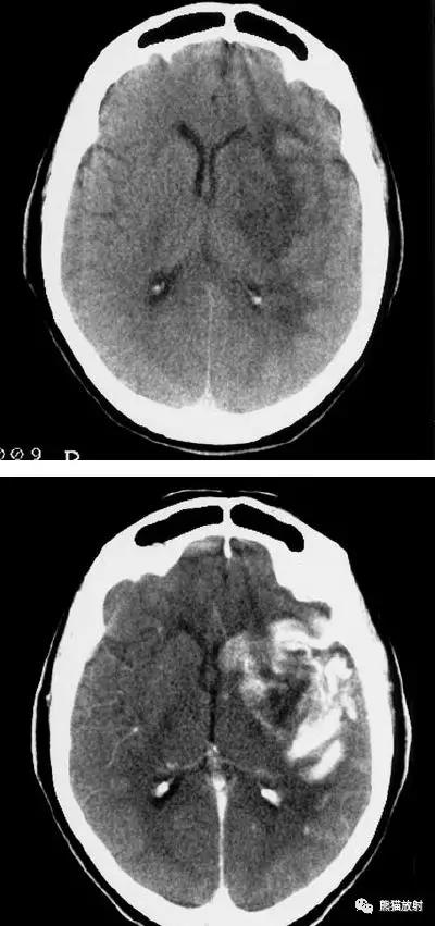各部位脑梗死ct影像讲解,脑梗死ct影像最简单的是什么表现