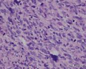 胚胎横纹肌肉瘤是怎么形成的,横纹肌肉瘤转移全身能活多久