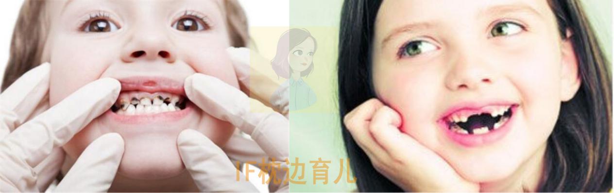 两岁宝宝有蛀牙刷牙的正确方法,宝宝牙齿清洁喷雾防止蛀牙