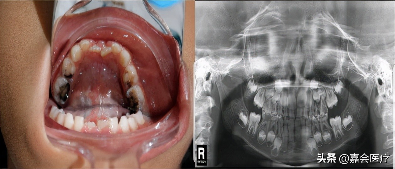 儿童龋齿产生的原因,儿童龋齿是什么意思