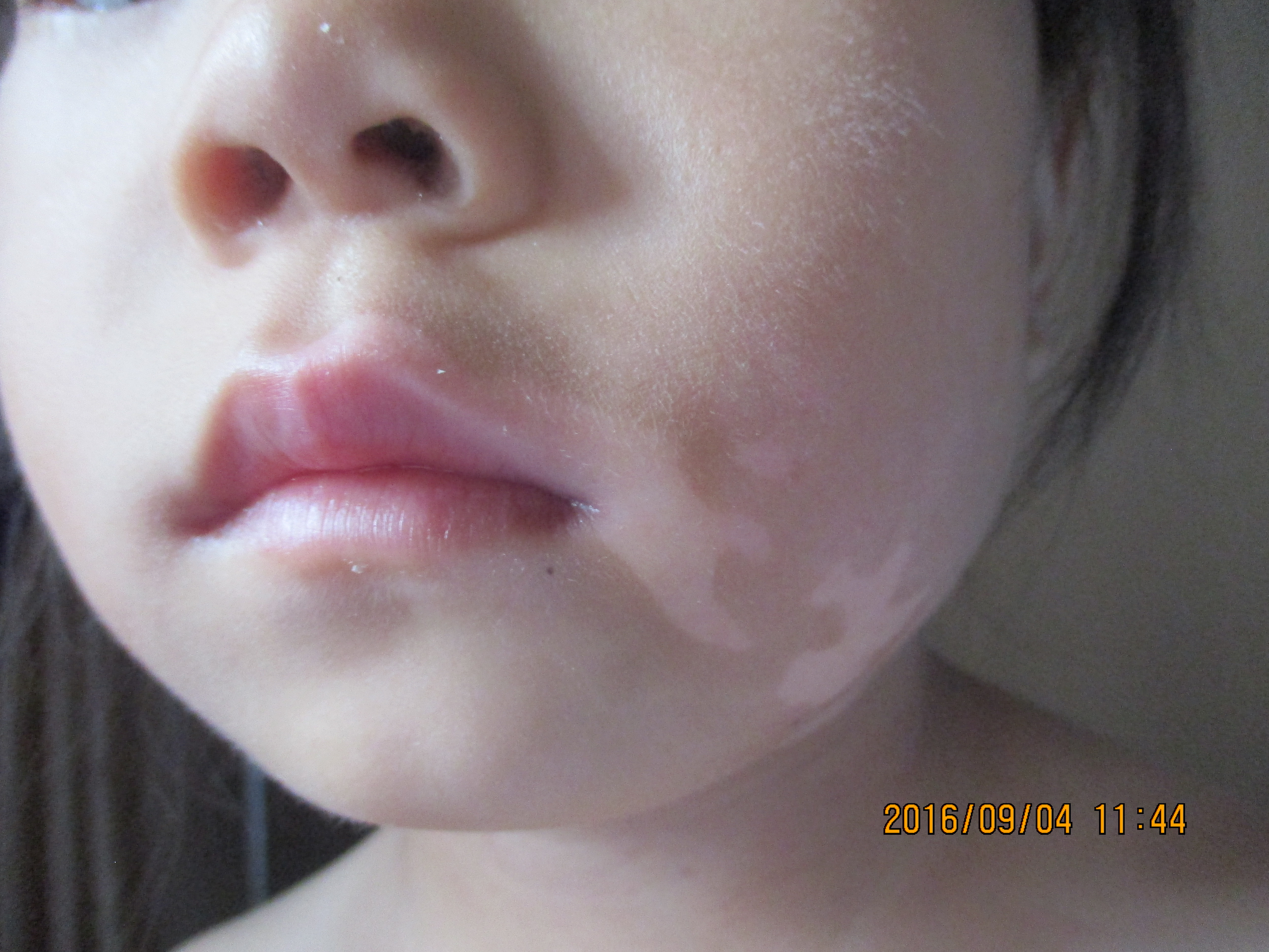 小孩脸上长白斑怎么办,儿童脸部长白斑怎么办