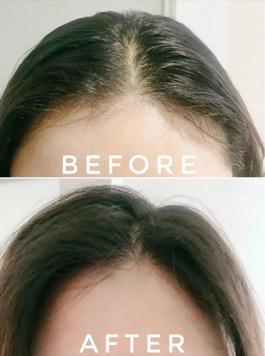 头皮痒螨虫成千上万,头皮痒是病的前兆螨虫作怪吗