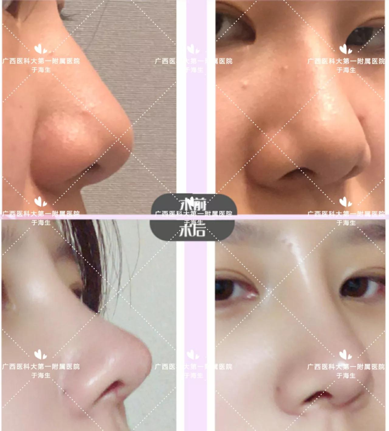 脸部微整形风险,脸部微整形图片大全