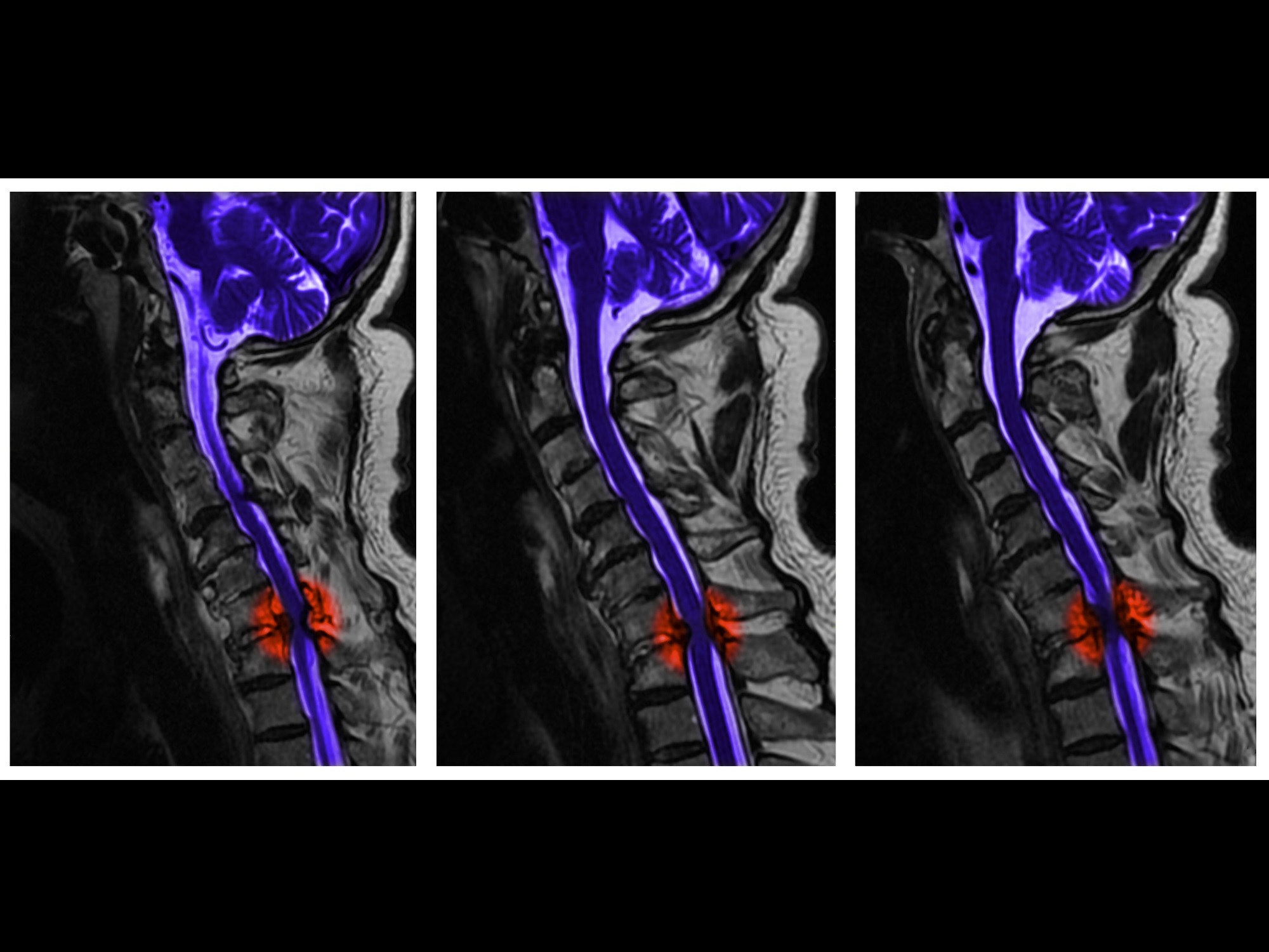 截瘫患者照顾,专业护理瘫痪老人