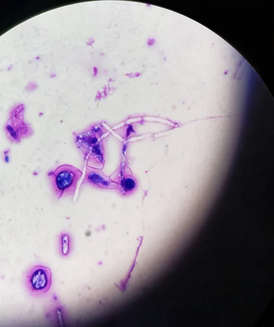 医生的恶魔,病人的死神!噬血细胞综合征来袭,生死边缘