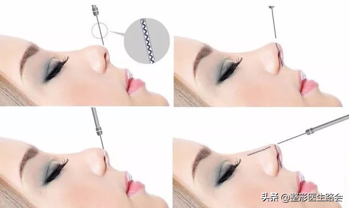 线雕隆鼻和软骨隆鼻哪个好,线雕隆鼻跟假体隆鼻哪个好看