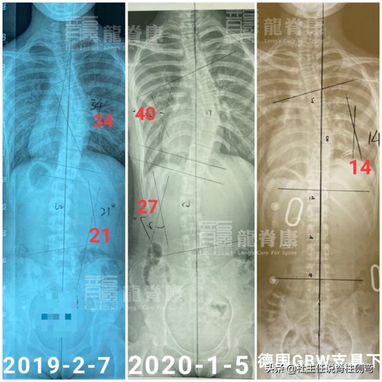 女孩17岁脊柱侧弯有加重现象,12岁女孩脊柱侧弯戴支具能恢复吗